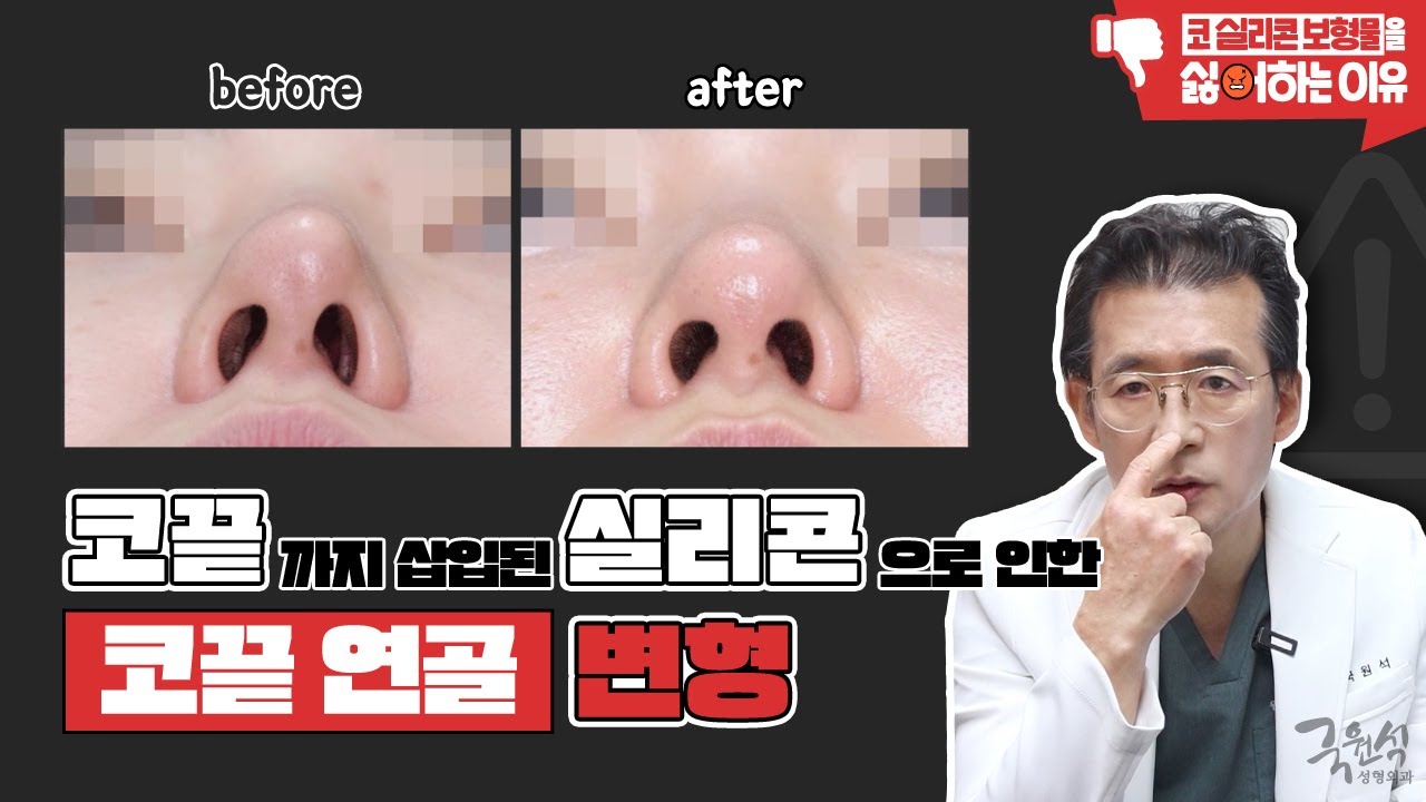 코 성형 후 코끝이 변형되었어요..!! 가장 확실하게 교정하는 방법은? 썸네일