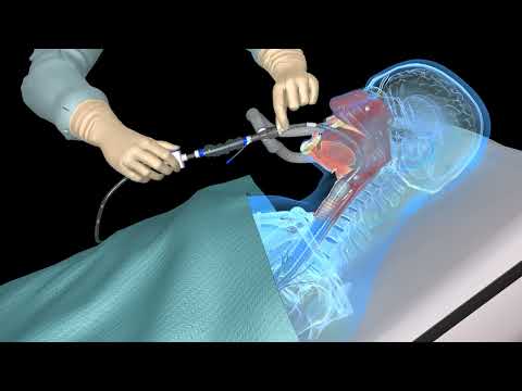 Suctioning the endotracheal tube - medical animation