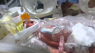 Download lagu Bayi prematur 7 bulan berat 1.1 kg mp3