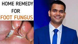 ROMOVE FOOT AND TOENAIL FUNGUS | SIMPLE HOME REMEDY