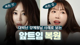 와… 앞트임 복원으로 이렇게나 인상이 달라진다고?! (ft. 마인드성형외과 - 정민경 원장님)