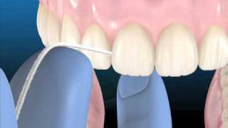 Técnicas de Higiene Oral. Técnicas Complementarias (cepillo interdental e hilo dental) - AB Santa Coloma Clínica Dental