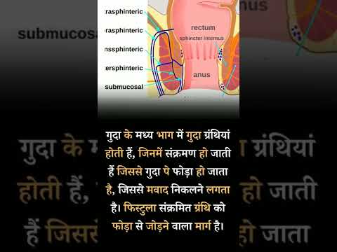 फिस्टुला (Fistula) क्या है ?fistula #fistulaanal #fistulas #cassiafistula #fistulatreatment