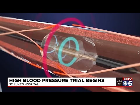 KCTV | Renal Denervation Helping Patients Combat Hypertension