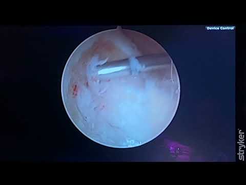 How Long Until You Can Walk Normally After a Bone Graft Surgery ASK DR MOORE