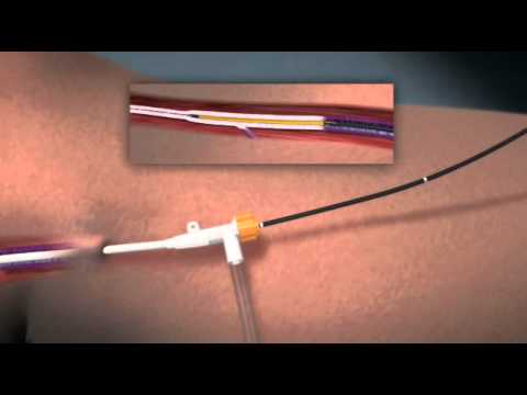 Saphenous Vein Ablation with Radiofrequency Technology (RFA)
