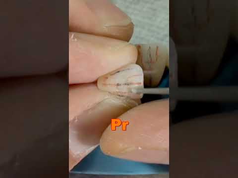 Learn to Contour Anterior Teeth #emax #smile