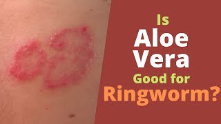 Aloe Vera for Ringworm - How Good Is It to Use for Ringworm?