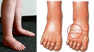 What Causes Water Retention (Edema) and How to Avoid It