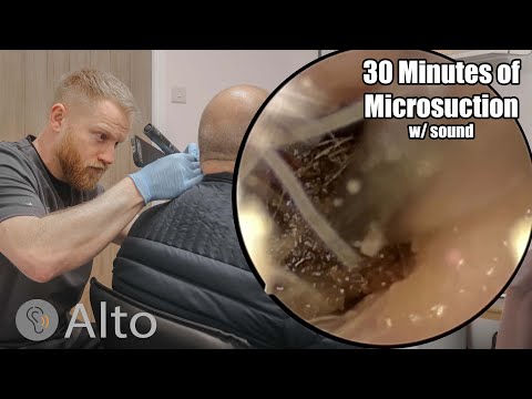 30 Minutes of MICROSUCTION Ear Wax Removal #022