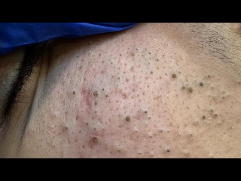 Deep Facial Cleansing for Acne | Blackheads and Whitehead Removal