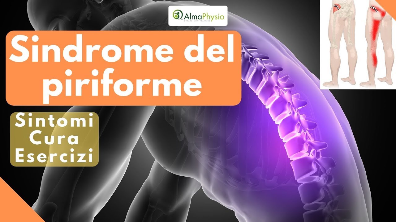 Watch Now Sindrome del piriforme: sintomi, cura, esercizi Sindrome del piriforme: sintomi, cura, esercizi