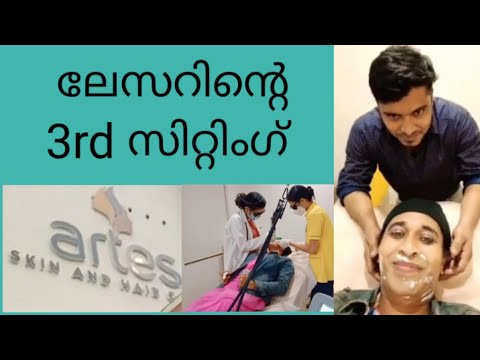 laser treatment 3rd sitting Artes Palakkad