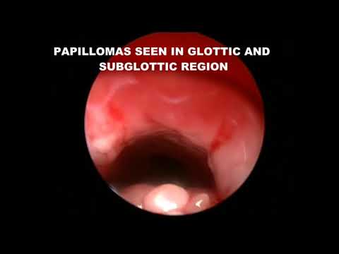 Papillomas of ear