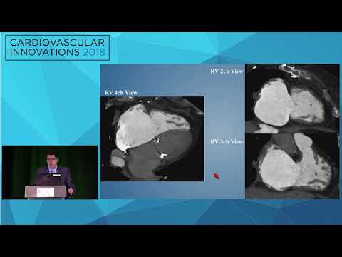 CVI2018 Session: What you can learn from CT imaging for procedure planning - Joao Cavalcante, MD