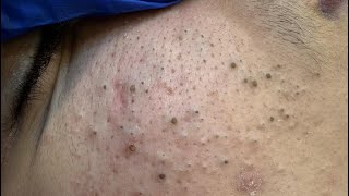 Download lagu ASMR Deep Cleansing for Acne-Free Skin - Pimple Popping & Blackhead Removal Techniques mp3