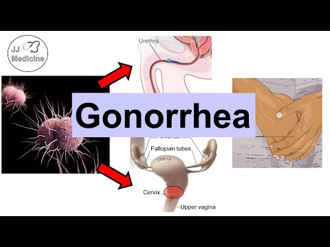 Gonorrhea (Neisseria Gonorrhea) | Pathophysiology, Symptoms & Complications, Diagnosis, Treatment