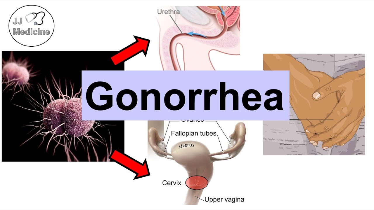 Gonorrhea (Neisseria Gonorrhea) | Pathophysiology, Symptoms & Complications, Diagnosis, Treatment