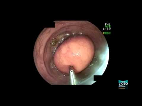 Lipoma de colon