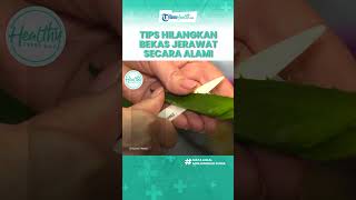 Tanpa Obat, Begini Cara Alami Hilangkan Bekas Jerawat hanya di Rumah