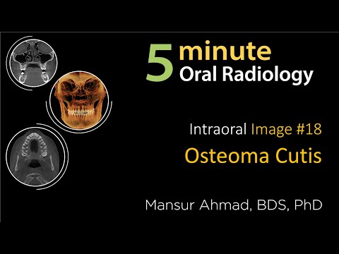 Osteoma Cutis: Intraoral radiographic interpretation