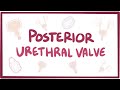 Posterior urethral valve (PUV) - causes, symptoms, diagnosis, treatment, pathology