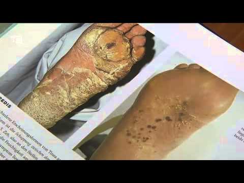 Camere dei bambini di crema a dermatite atopic Siccome è trattato neurodermatitis