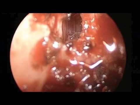 Leak of Cerebrospinal Fluid through Cribriform Plate of Ethmoid and Repair of Defect