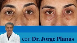 Cómo tratar los xantelasmas