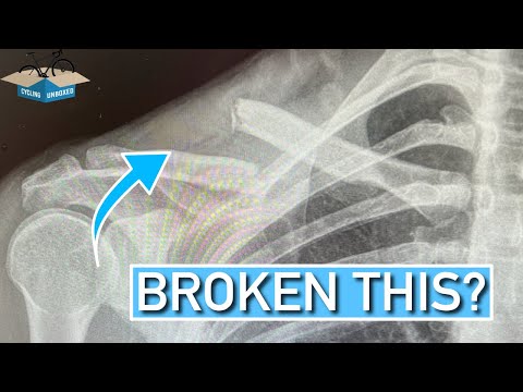 Broken your Clavicle? Here is what to do (collar bone)