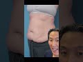 Tummy Tuck REVEAL Shorts Tummytuck