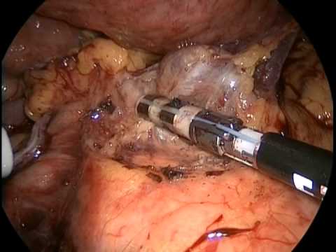 Laparoscopic Subtotal Gastrectomy with Gastrojejunostomy