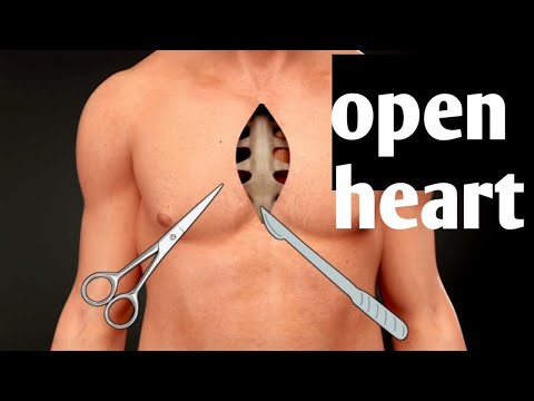 Open Heart Surgery: From Incision to Closure