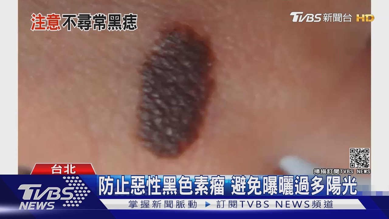 有片/「這部位」長黑痣確診惡性黑色素癌 醫師警告別忽略它!