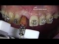 New Way to Extract Teeth?!