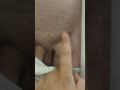 Pre Op Lymphocele Right Inguinal