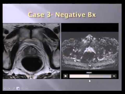 Calculse prostatitis MKB 10