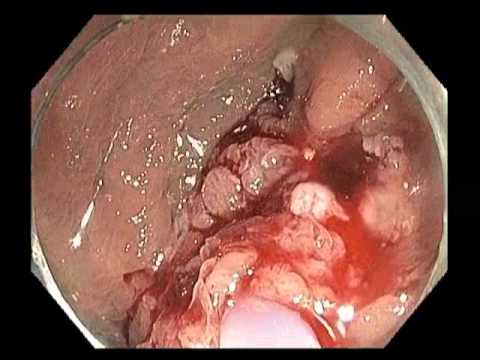  Flat Lesion in Cecum - Difficulties in EMR