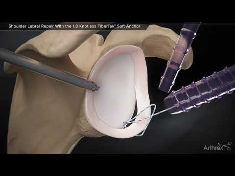 Shoulder Labral Repair With the 1.8 Knotless FiberTak® Soft Anchor