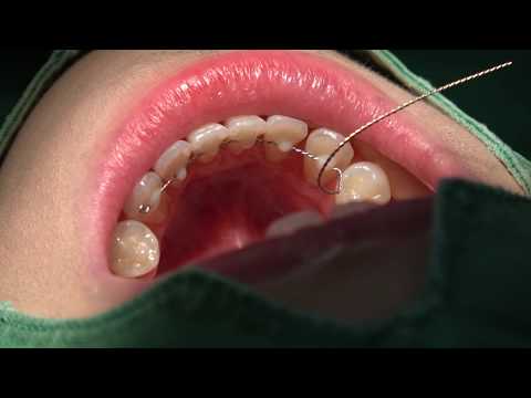 download lagu mp3 mp4 Permanent Retainer Cost, download lagu Permanent Retainer Cost gratis, unduh video klip Permanent Retainer Cost