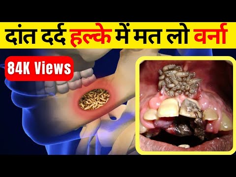 दांत में दर्द का इलाज | Dant mein dard ka ilaj | दांत में सडन | Tooth Pain | Tooth Cavity