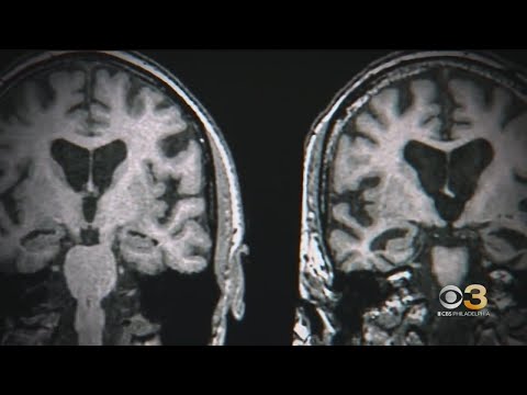 Previously unknown long term symptoms for some patients with traumatic brain injuries