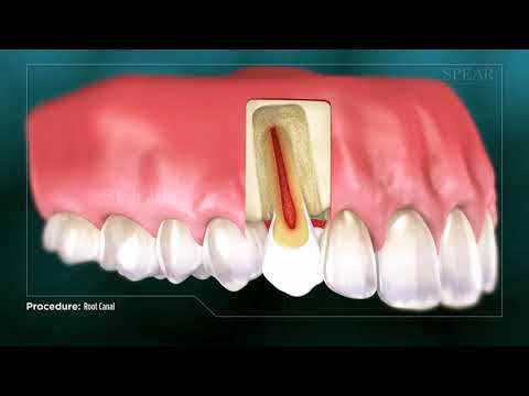 What Is Root Canal Treatment?