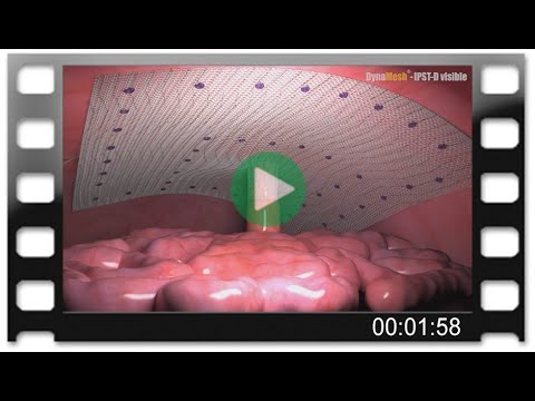 DynaMesh®-IPST-D visible – Animation: Parastomal Hernia Repair with Chimney Technique