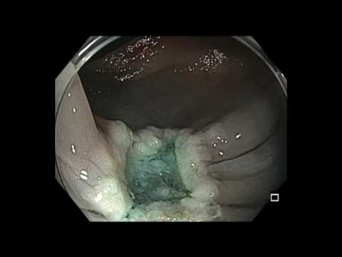 Colonoscopia: resección endoscópica de la mucosa de pólipo rectal 