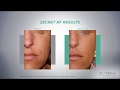 Introducing Secret RF Cutera