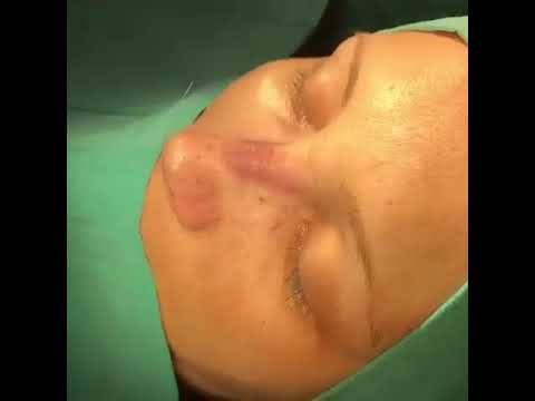 Op. Dr. Ayşe Karakaya | Eskişehir Rhinoplasty | #Rhinoplasty #NoseAesthetics #Discover #HealthTourism