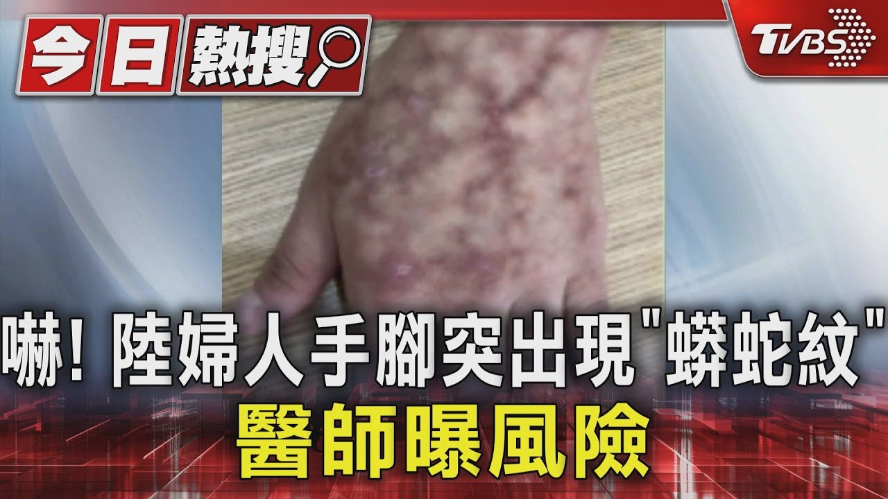 嚇！陸婦人手腳突出現「蟒蛇紋」　醫師曝風險