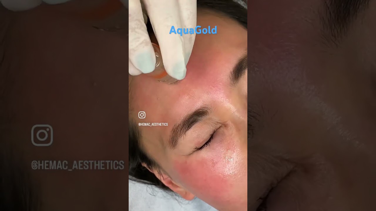 AquaGold for brighter fresher skin 🌟 #melbourneskin