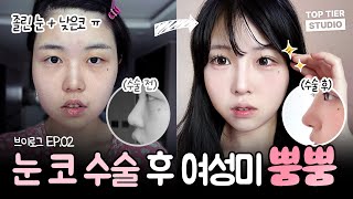 [눈‧코 성형 리얼후기 브이로그] 자연스럽게 여성스러운 이미지로 변신!✨[2편]ㅣ탑티어성형외과